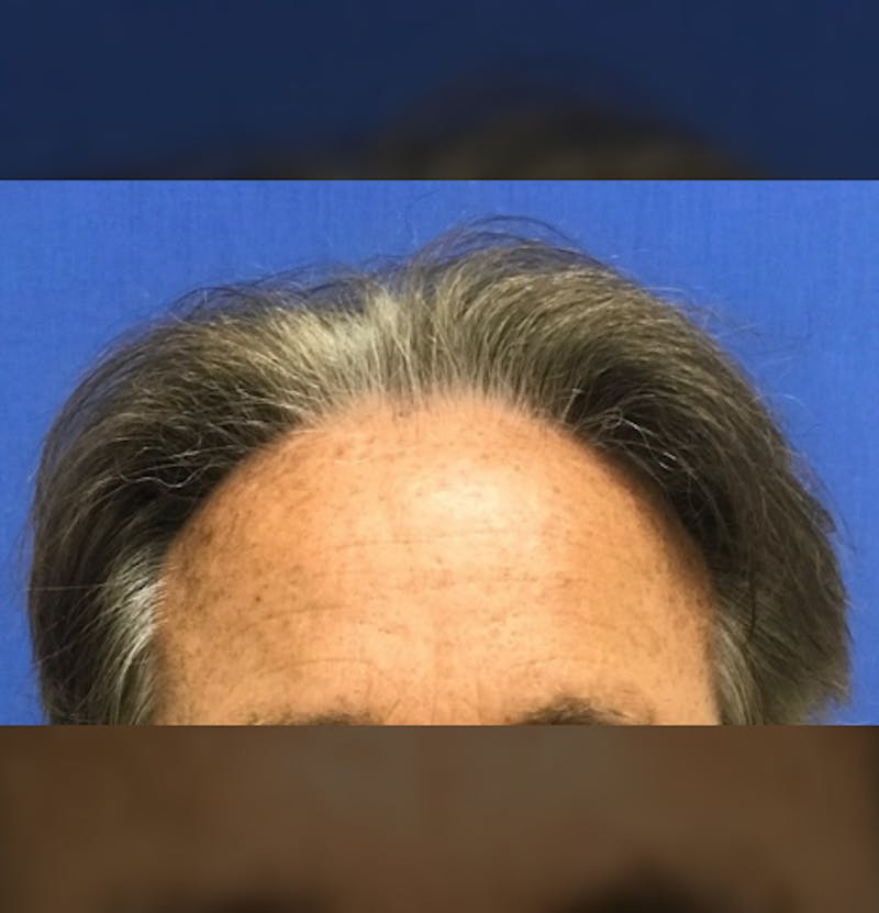 Male Surgical Gallery Before & After Gallery - Patient 279020 - Image 3