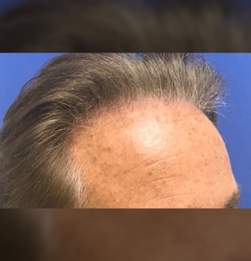 Male Surgical Gallery Before & After Gallery - Patient 279020 - Image 5