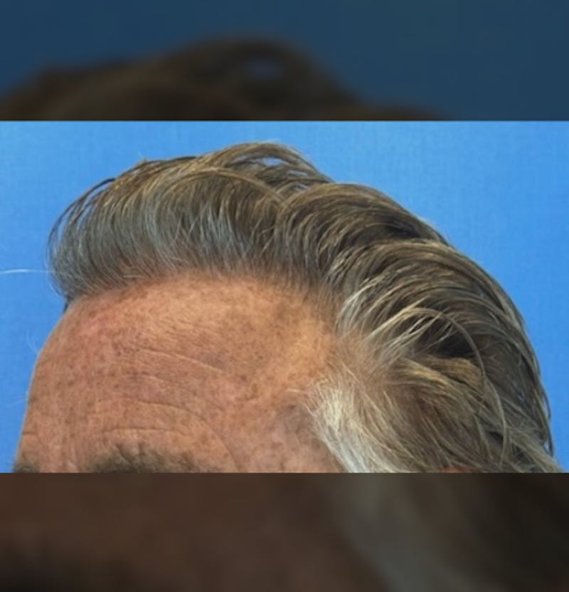 Male Surgical Gallery Before & After Gallery - Patient 279020 - Image 8