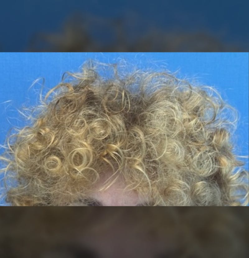Non-Surgical Gallery Before & After Gallery - Patient 267760 - Image 4