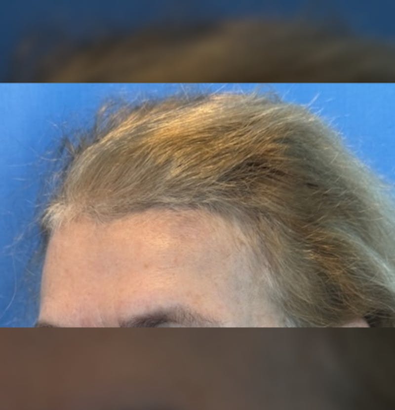 Non-Surgical Gallery Before & After Gallery - Patient 267760 - Image 9