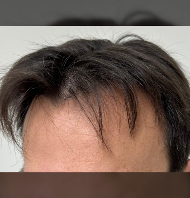 Non-Surgical Gallery Before & After Gallery - Patient 160987 - Image 10