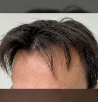 Non-Surgical Gallery Before & After Gallery - Patient 160987 - Image 10