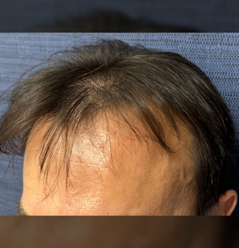 Non-Surgical Gallery Before & After Gallery - Patient 160987 - Image 9