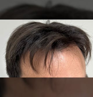Non-Surgical Gallery Before & After Gallery - Patient 160987 - Image 8