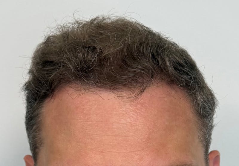 Male Surgical Gallery Before & After Gallery - Patient 272050 - Image 2