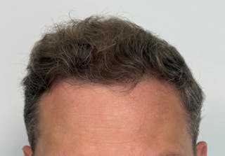 Male Surgical Gallery Before & After Gallery - Patient 272050 - Image 2