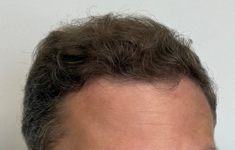 Male Surgical Gallery Before & After Gallery - Patient 272050 - Image 4