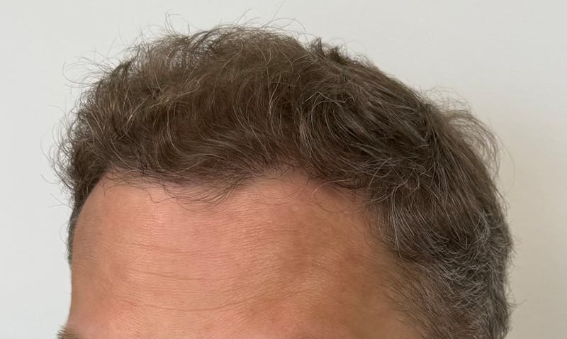 Male Surgical Gallery Before & After Gallery - Patient 272050 - Image 6