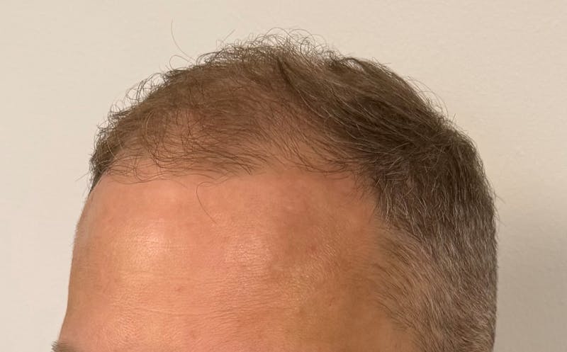 Male Surgical Gallery Before & After Gallery - Patient 272050 - Image 5