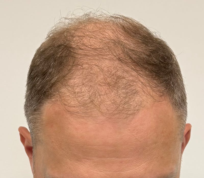 Male Surgical Gallery Before & After Gallery - Patient 272050 - Image 7