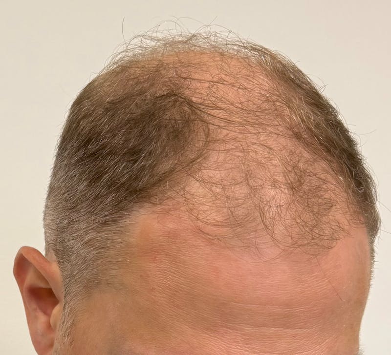 Male Surgical Gallery Before & After Gallery - Patient 272050 - Image 11