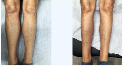 Spider Vein Treatments Before & After Gallery - Patient 181027318 - Image 1
