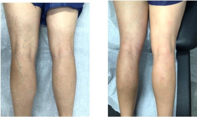 Spider Vein Treatments Before & After Gallery - Patient 181027319 - Image 1
