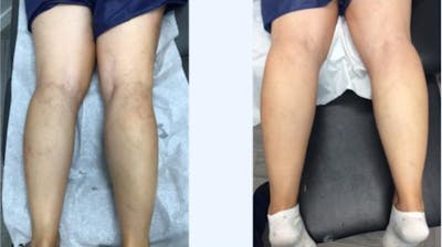 Spider Vein Treatments Before & After Gallery - Patient 181027320 - Image 1