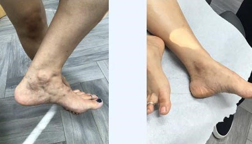 Spider Vein Treatments Before & After Gallery - Patient 181027321 - Image 1