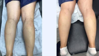 Spider Vein Treatments Before & After Gallery - Patient 181027322 - Image 1