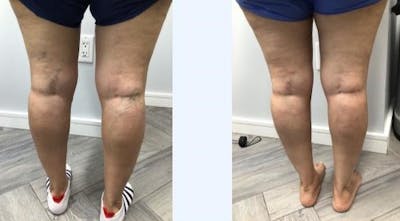 Spider Vein Treatments Before & After Gallery - Patient 181027323 - Image 1