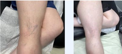Spider Vein Treatments Before & After Gallery - Patient 181027324 - Image 1