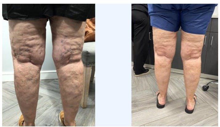 Spider Vein Treatments Before & After Gallery - Patient 181028145 - Image 1