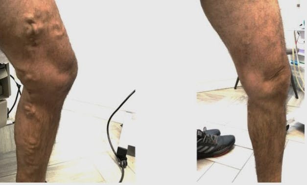 Varicose Vein Treatment Before & After Gallery - Patient 181032622 - Image 1