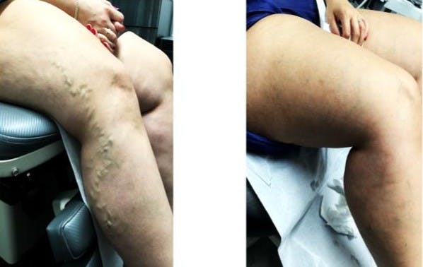 Varicose Vein Treatment Before & After Gallery - Patient 181032625 - Image 1