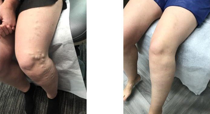 Varicose Vein Treatment Before & After Gallery - Patient 181032628 - Image 1