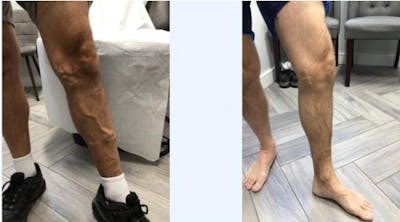 Varicose Vein Treatment Before & After Gallery - Patient 181032631 - Image 1