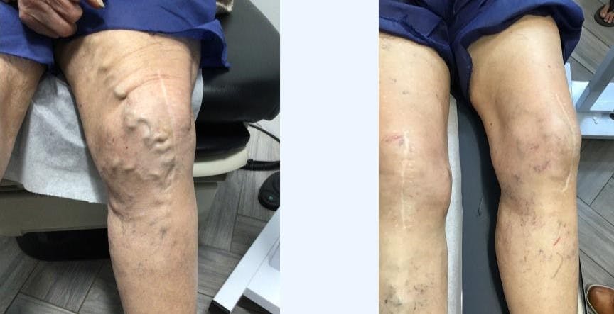 Varicose Vein Treatment Before & After Gallery - Patient 181032634 - Image 1