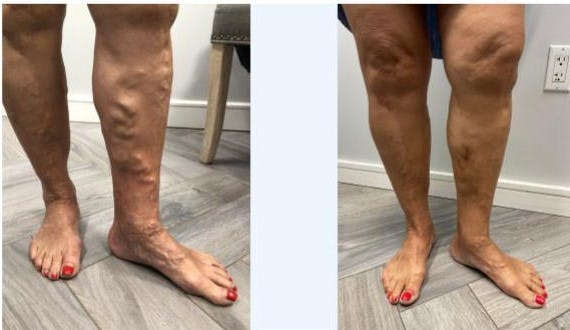 Varicose Vein Treatment Before & After Gallery - Patient 181032683 - Image 1