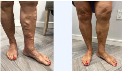 Varicose Vein Treatment Before & After Gallery - Patient 181032683 - Image 1