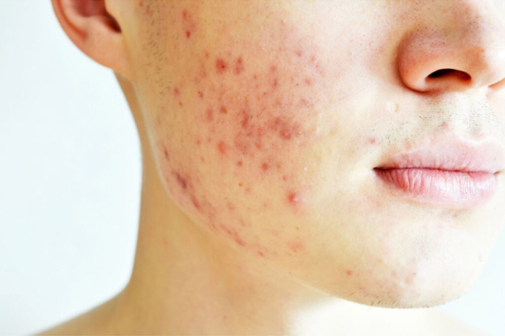 5 Things You Should Know About Removing Acne Scars With Laser