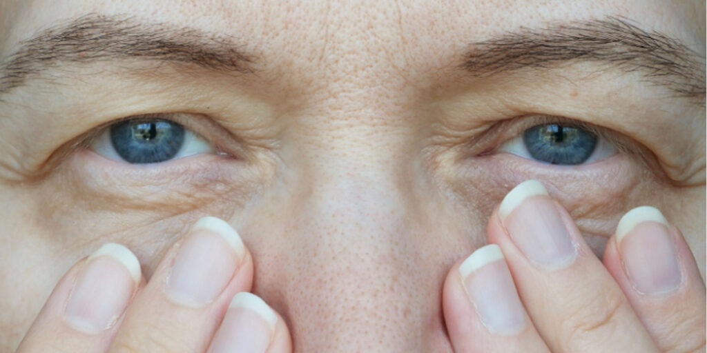 Drooping Eyebrow After Botox Treatment Botox Denver, CO