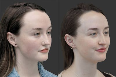 Earlobe Repair Before & After Gallery - Patient 174997235 - Image 1