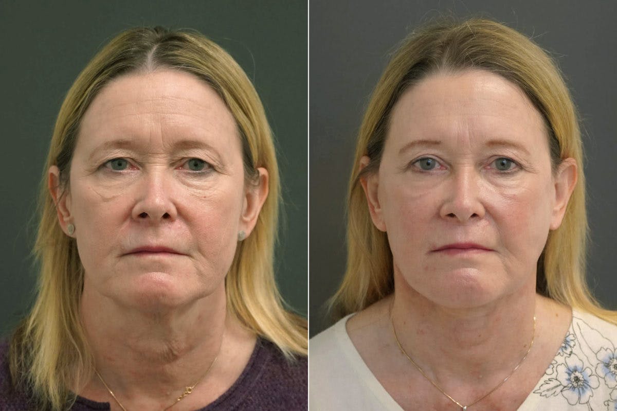 Facelift Before & After Gallery - Patient 174998036 - Image 1