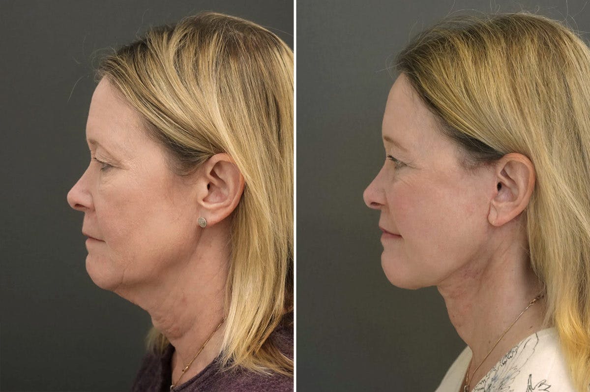 Facelift Before & After Gallery - Patient 174998036 - Image 2