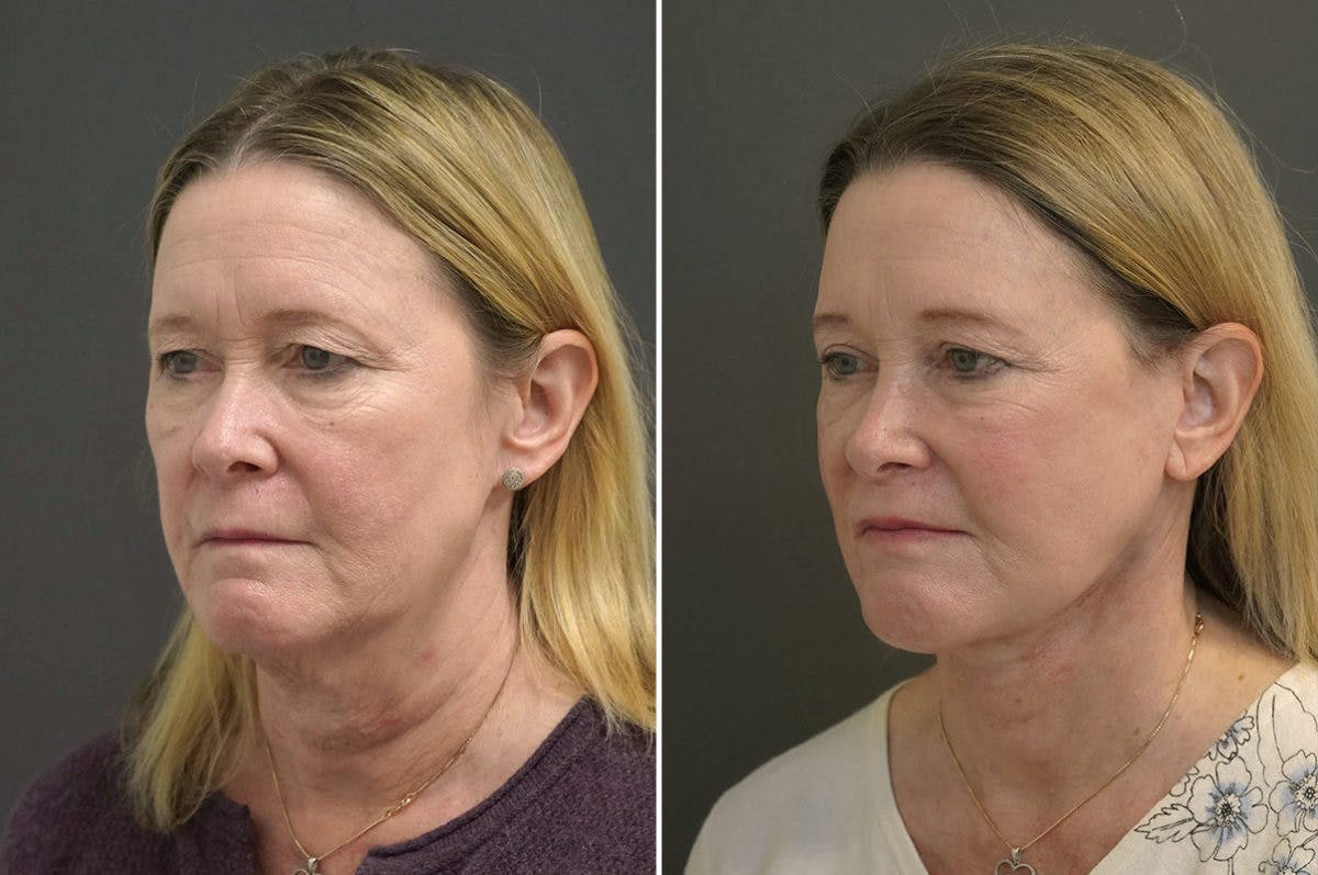 Facelift Before & After Gallery - Patient 174998036 - Image 3