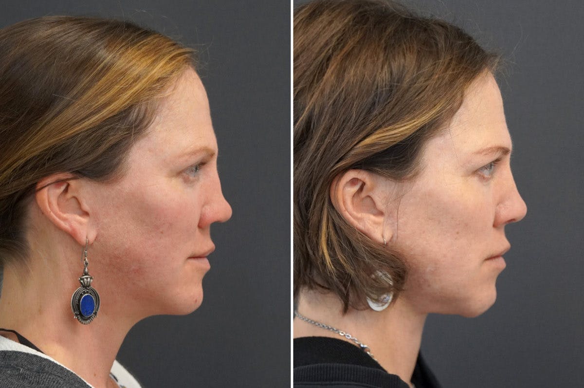 Revision Rhinoplasty Before & After Gallery - Patient 174998132 - Image 1