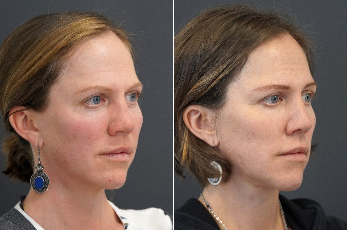 Revision Rhinoplasty Before & After Gallery - Patient 174998132 - Image 2