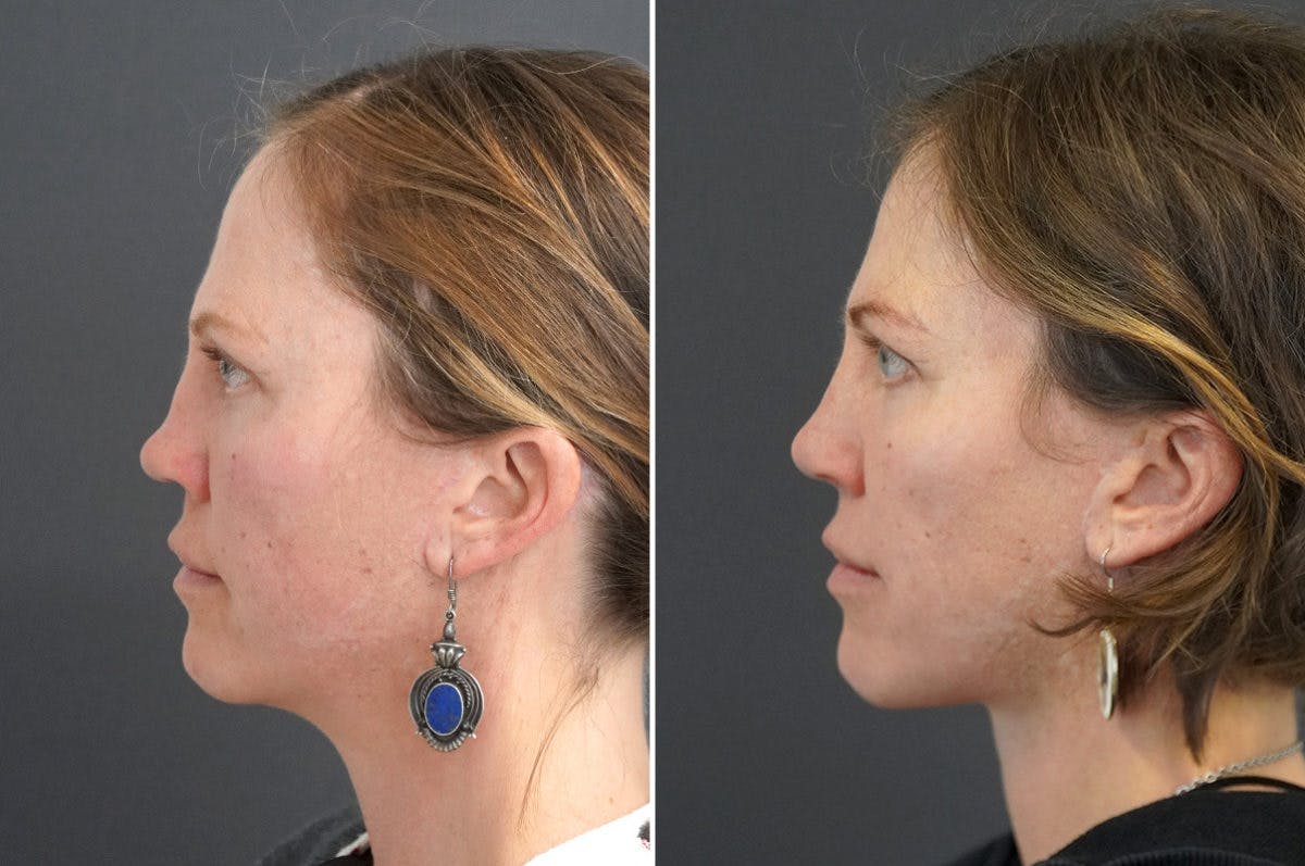 Revision Rhinoplasty Before & After Gallery - Patient 174998132 - Image 3