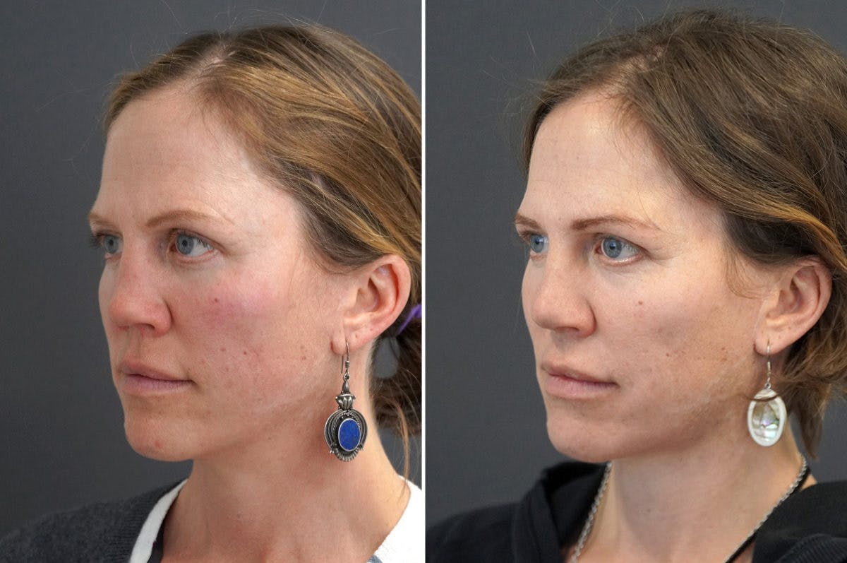 Revision Rhinoplasty Before & After Gallery - Patient 174998132 - Image 4