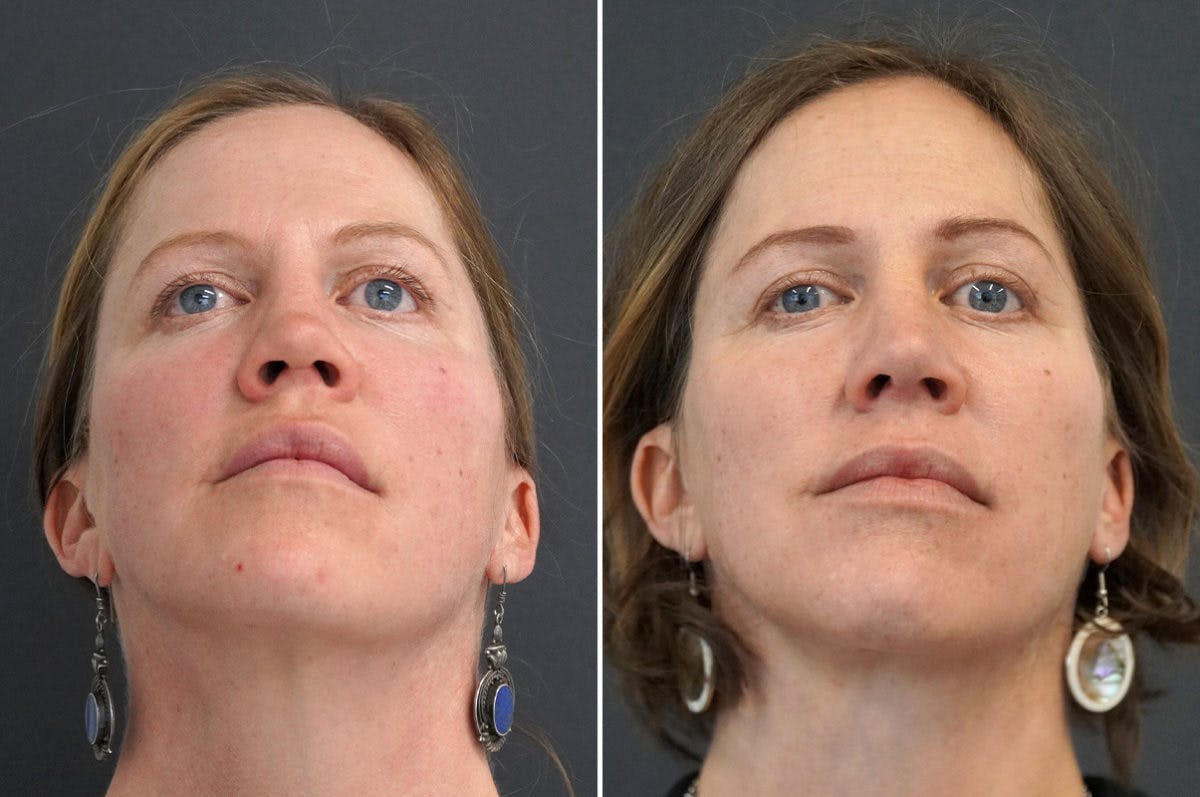 Revision Rhinoplasty Before & After Gallery - Patient 174998132 - Image 6