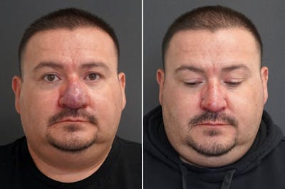 Rhinophyma Before & After Gallery - Patient 174998137 - Image 1