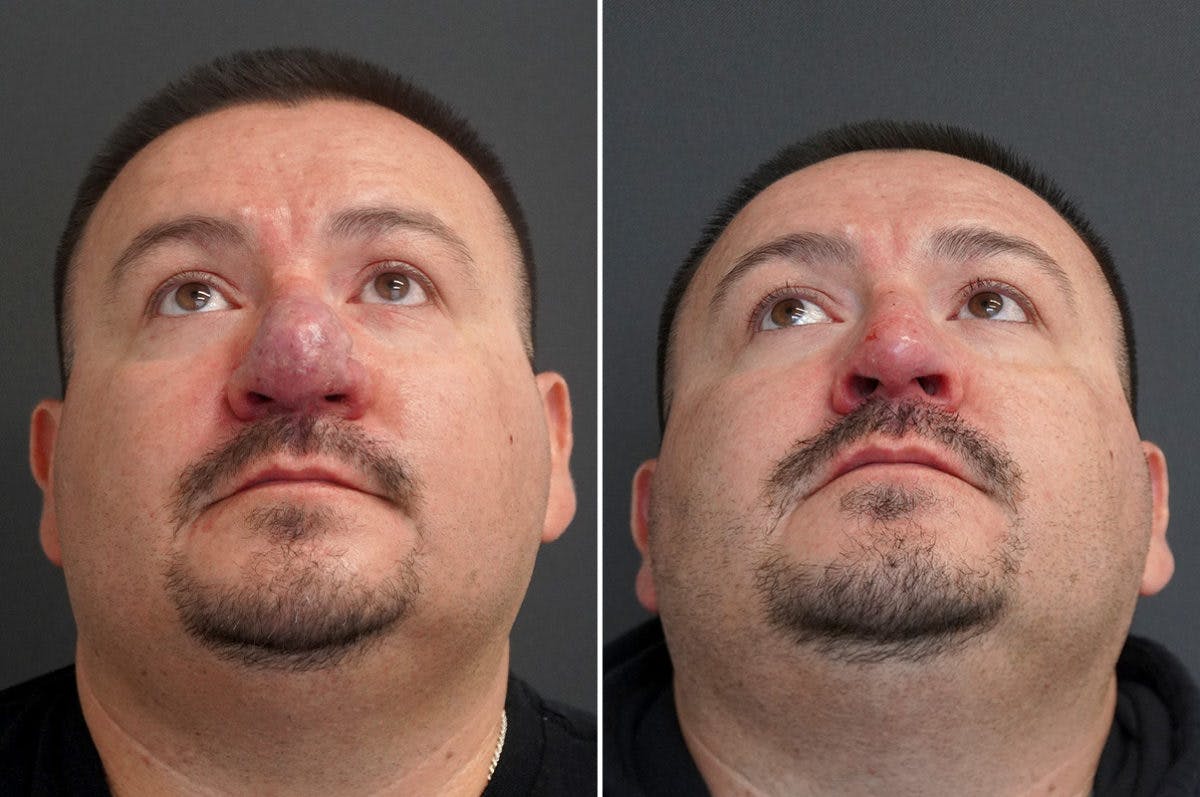 Rhinophyma Before & After Gallery - Patient 174998137 - Image 2
