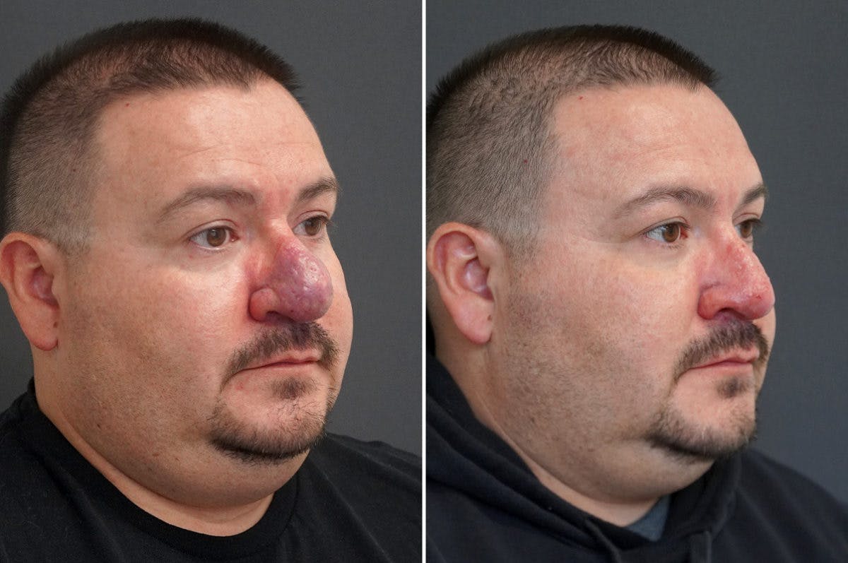 Rhinophyma Before & After Gallery - Patient 174998137 - Image 3