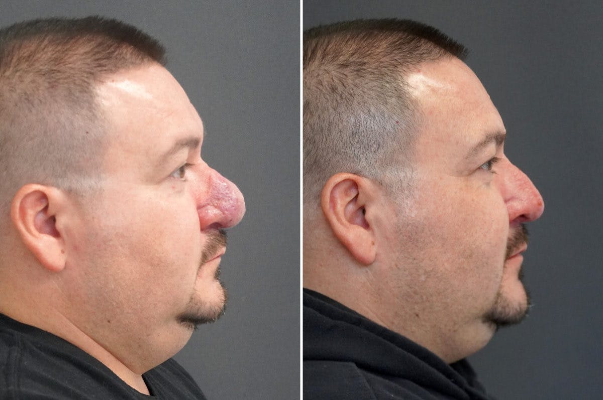 Rhinophyma Before & After Gallery - Patient 174998137 - Image 4