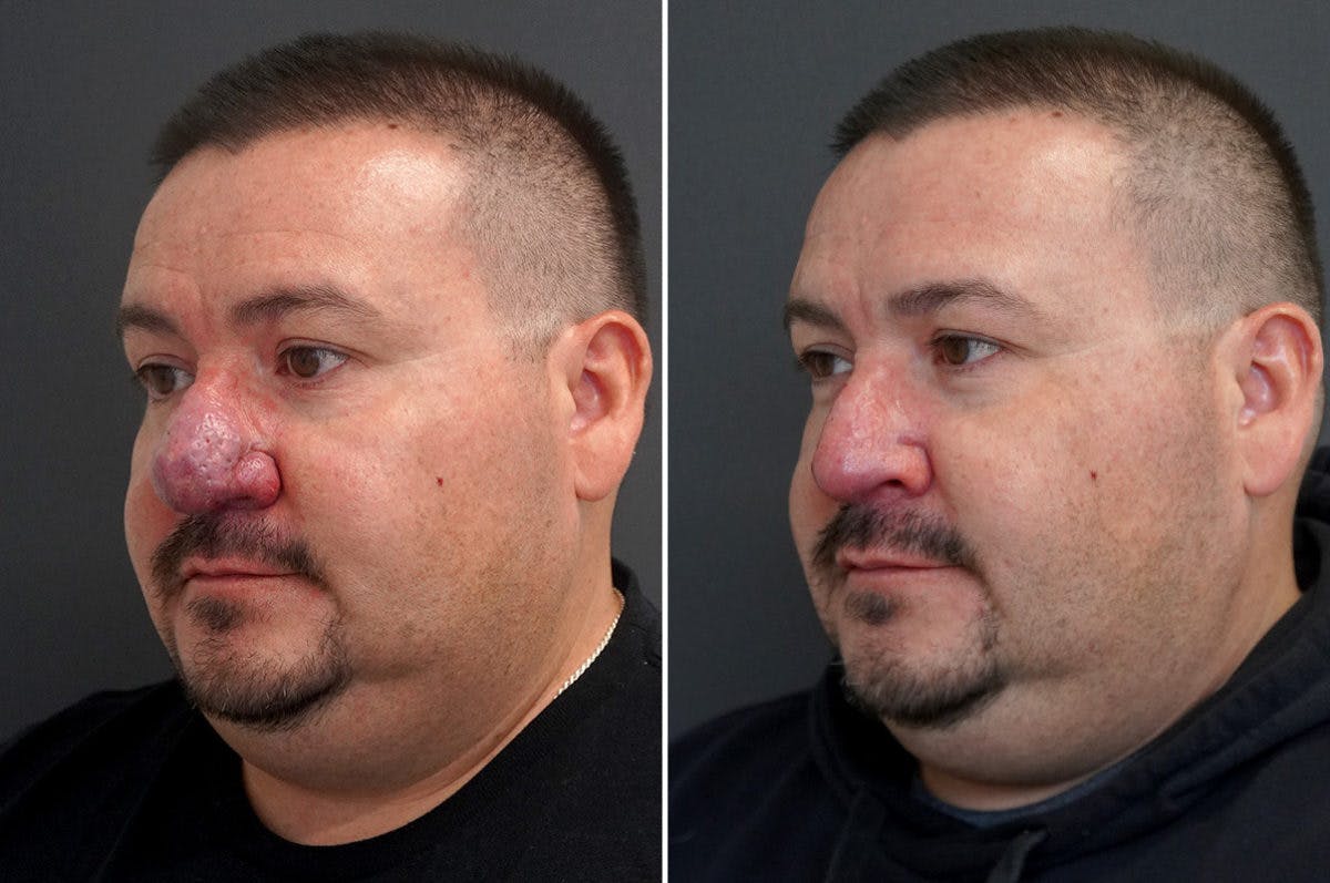 Rhinophyma Before & After Gallery - Patient 174998137 - Image 5