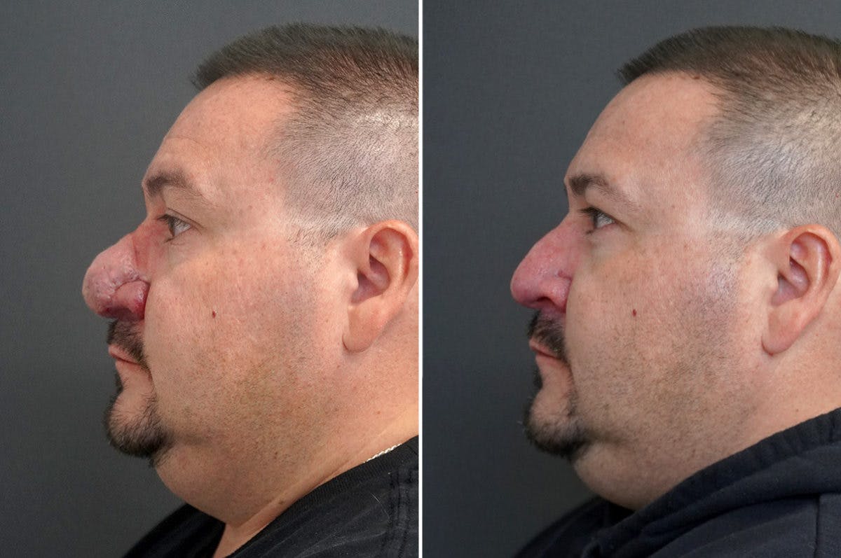 Rhinophyma Before & After Gallery - Patient 174998137 - Image 6