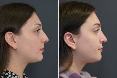 Rhinoplasty Before & After Gallery - Patient 174998162 - Image 1