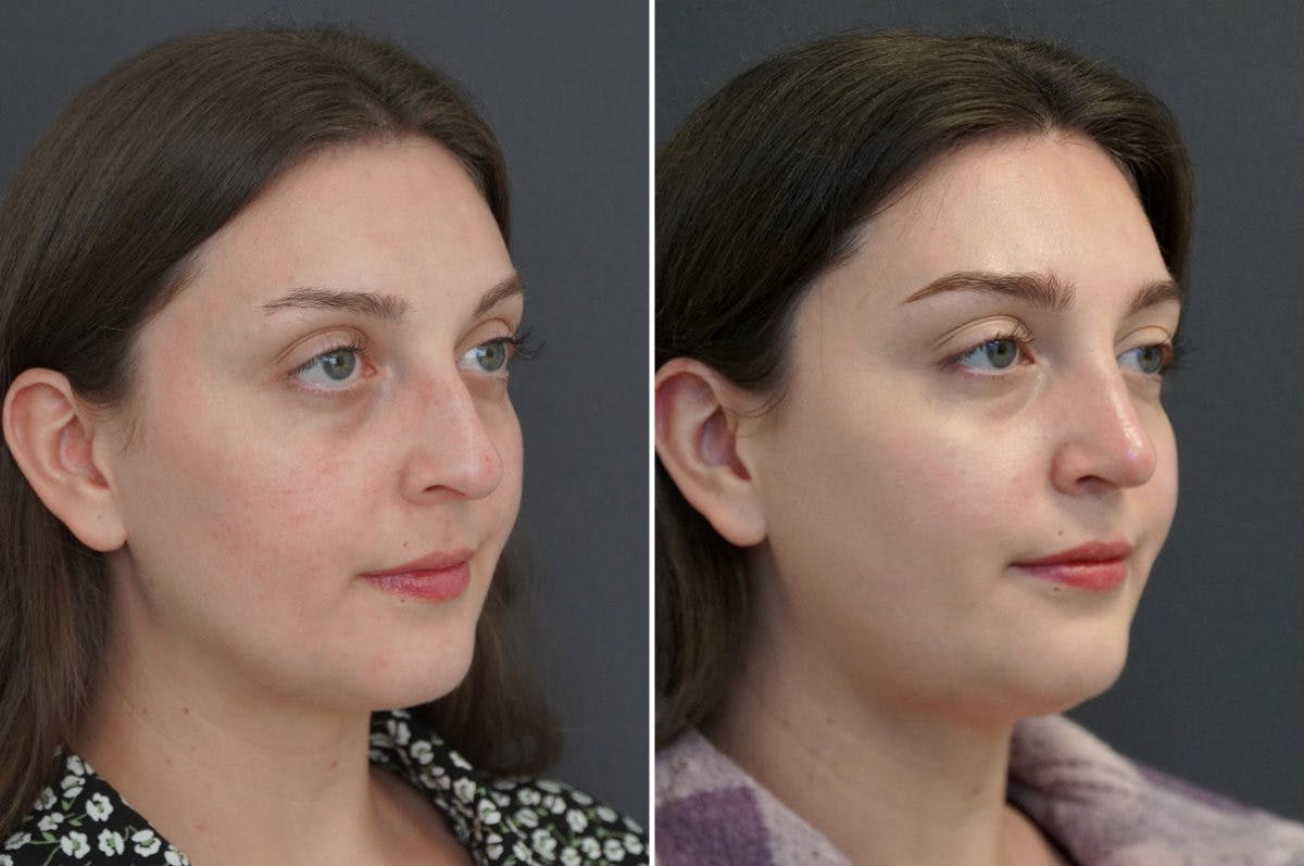 Rhinoplasty Before & After Gallery - Patient 174998162 - Image 2